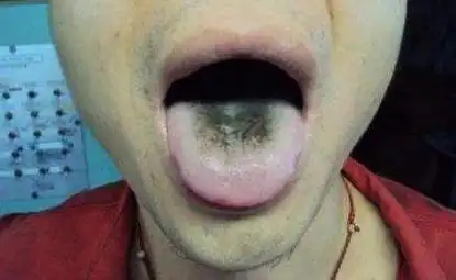 舌头发黑是怎么回事:可大可小原因揭晓(图)