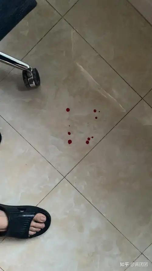 大便依旧很疼,但是持续时间比以前缩短,而最头疼的是换药,自己在家换