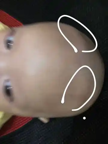 宝宝头上有两个凸出的骨头,正常吗?