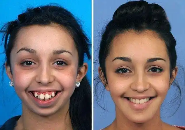 龅牙妹",后来,ellie jones为了改变自己的容貌,做了整容手术,从丑女