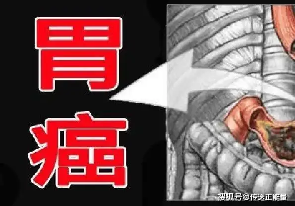 体内胃癌,饭后先知!若有这3"异常",必须引起重视