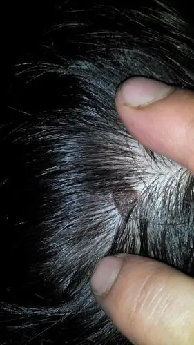 近几年发现我的头部长了一颗像痣一样的东西,但是软软的,今晚发觉怎么