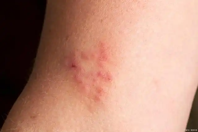 皮肤遭真菌感染反复发作让人苦不堪言综合治疗是关键