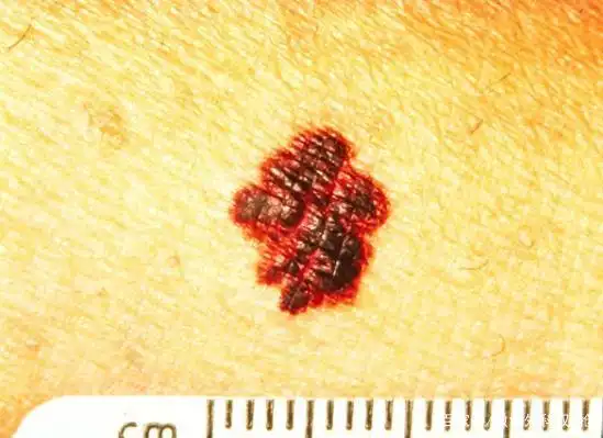 掌握abcde原则,教你肉眼判断黑色素瘤