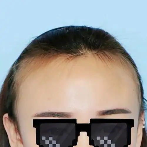 我的额头是真的超宽,让脸看起来也很宽.发际线两边后_圈子-新氧美容整