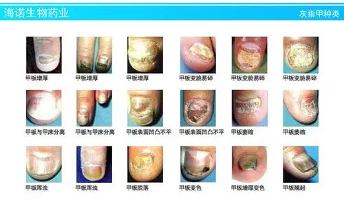 厂家直销 灰指甲药膏 灰甲修复膏 修复灰甲必备软膏 oem加工