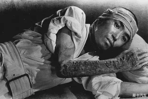 这名男子在广岛的一家医院被拍到他在仙田町受到辐射右臂烧伤