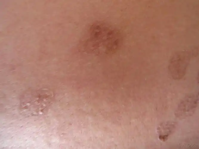 遗传性皮肤病请大家诊治