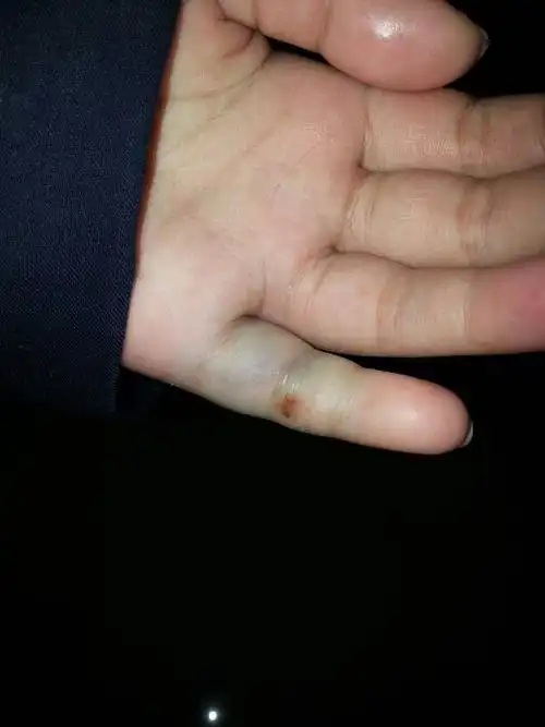 今天摔了手肿很大了要不要拍片