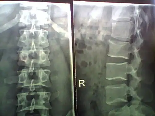 腰间盘骨刺怎么治疗