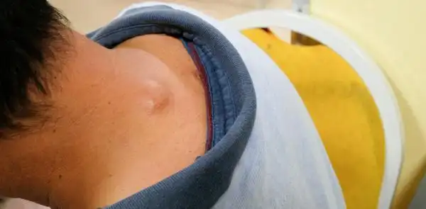 需要注意的是,很多患者会把囊肿,脂肪肉瘤等误认为是脂肪瘤,而忽视其