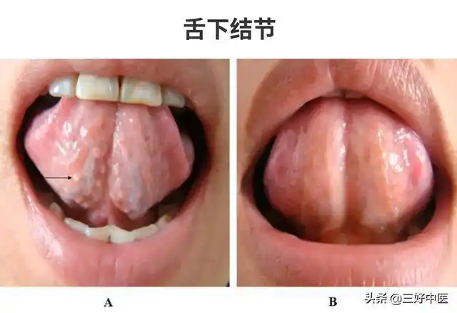 那就是看舌下是否有结节,通俗地说就是是否有很多颗粒状颜色白白的