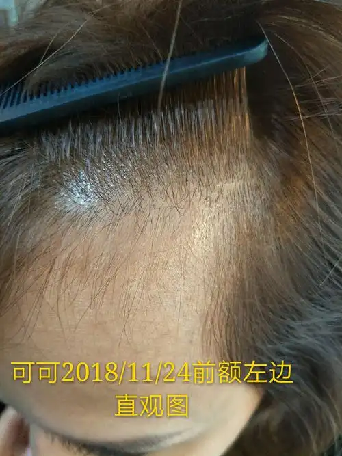 愿你头皮健康,青春永驻