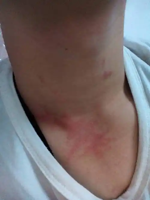 前两天脖子上突然长出这些红斑 怎么回事 是皮肤病吗 要去医院看吗