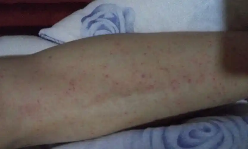 双下肢大量出血点