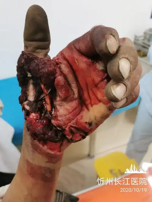 收割机绞伤致拇指掌侧毁损掌浅弓缺损一一忻州长江医院手外组
