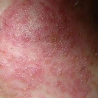 血热是外感热邪,热入血分,血受热邪所迫而妄行,导致出血,发斑等的