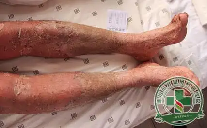 得到了,但是还有一些银屑病患者的病症变得严重,演变到了脓疱型银屑病