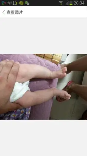 宝宝小腿不直,同龄的宝宝们有同样的问题吗?