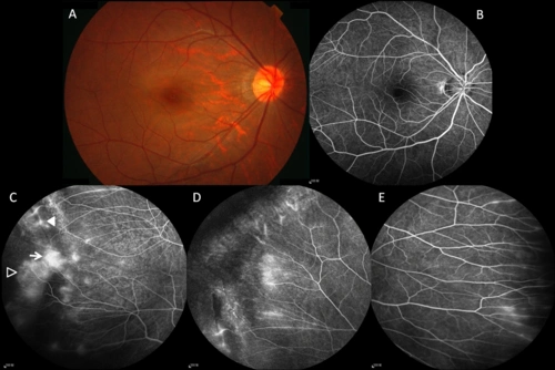 posterior pole retinal abnormalities in mild asymptomatic fevr
