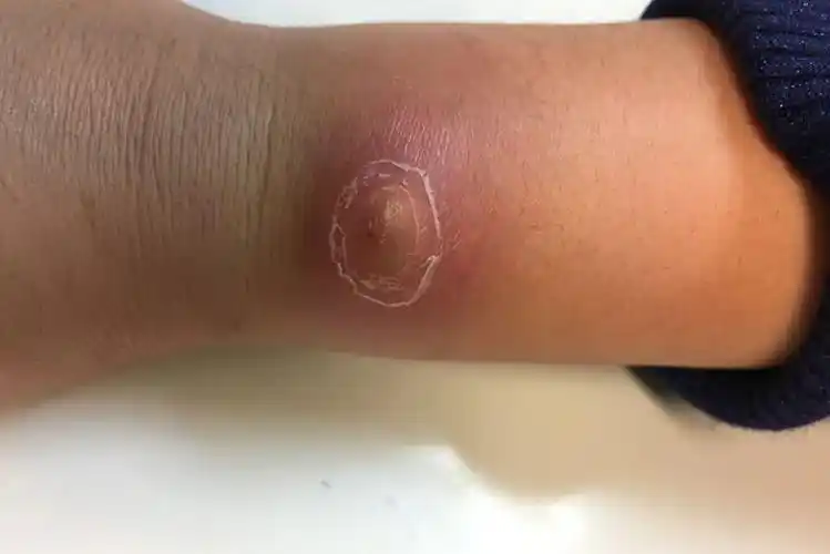 手上长毒疮图片