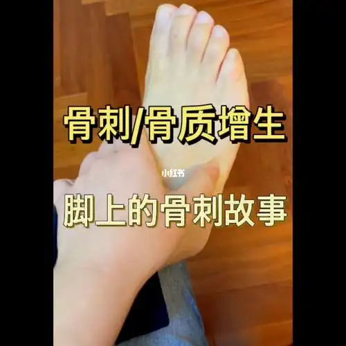 骨刺骨质增生脚上长了骨刺故事