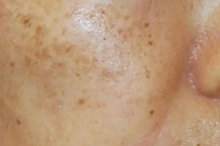 黄褐斑黄褐斑主要分布于面颊部,双侧对称,形如蝴蝶的斑块斑片.