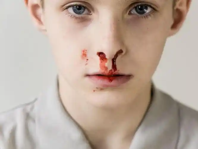 流鼻血的危害有哪些