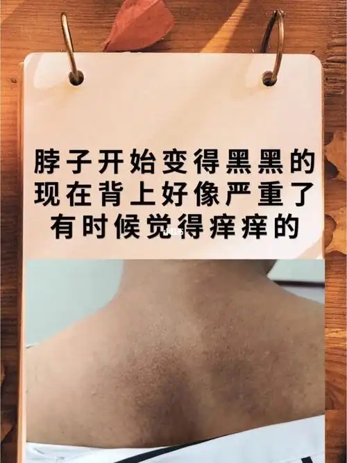 后背上黑黑的皮肤淀粉样变还有机会变白吗