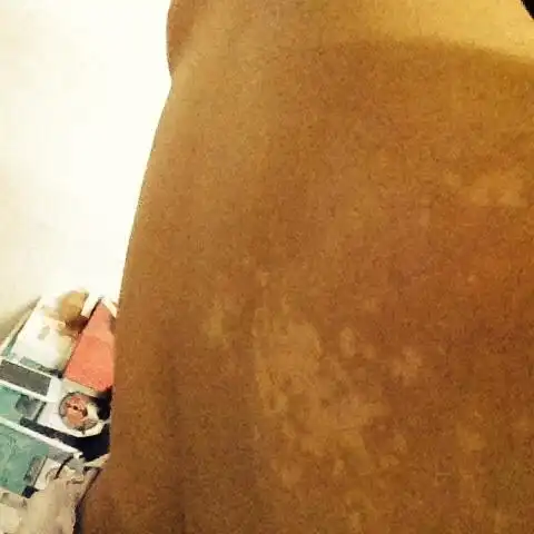 你好,背部长白斑是什么原因?图片你能确定病情吗?_皮肤科_邻医网