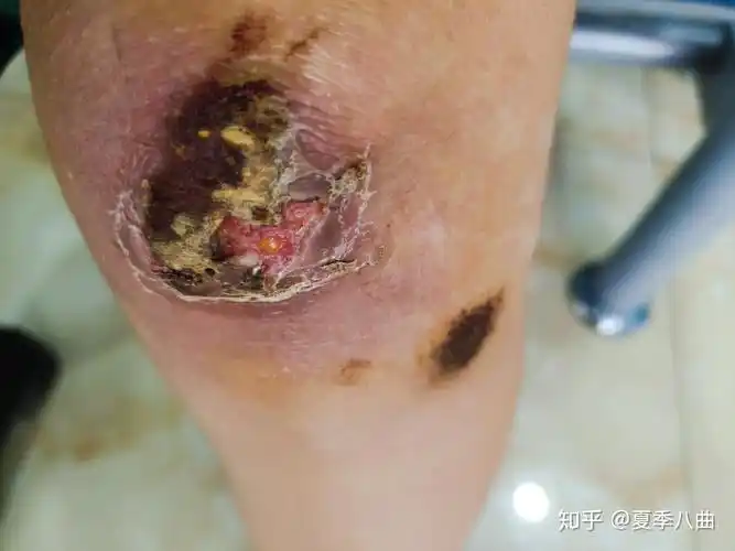 膝盖撞伤,感染发炎,痂下化脓 - 知乎