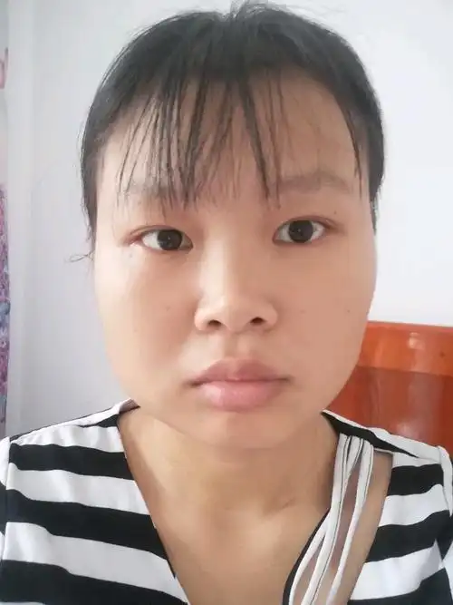 脸部下颚太宽下巴短看着就像没下巴似的该做哪种手术才能好点 我不要v