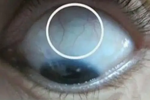 慢性单纯性青光眼早期图片