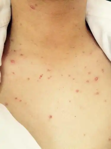 得了疥疮,身上大面积红色丘疹,大夫让使用硫磺软膏3天,说3天后洗澡