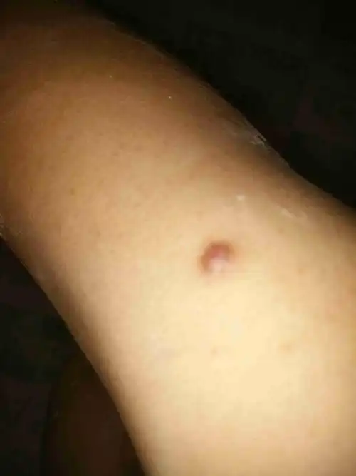 手臂上张了个疙瘩是怎么回事,平时有点痒