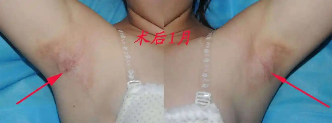 腋臭术后恢复效果图 - 好大夫在线