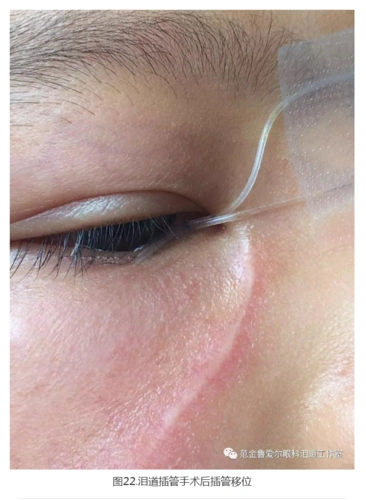 【范金鲁泪道系列-3】鼻腔内窥镜下泪道手术方法教学系列