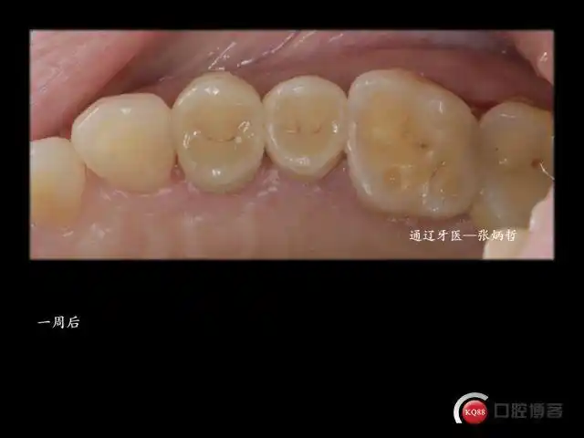 两颗双尖牙的死与生