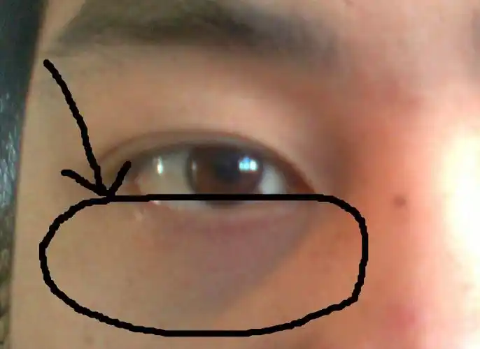 我眼睛下面这部分一直是黑的,是不是缺少什么维生素啊?