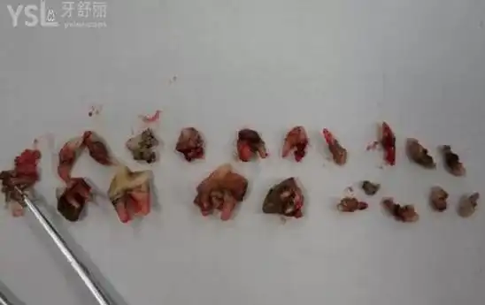 烂牙根需要怎么处理以及烂牙根拔出后的图片