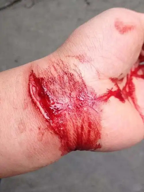 > 女,一年前因感情纠纷过度自责 给自己造成严重自残 并轻生未成功 .