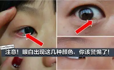 眼白出现这几种颜色,你该警惕了!为家人看一看!