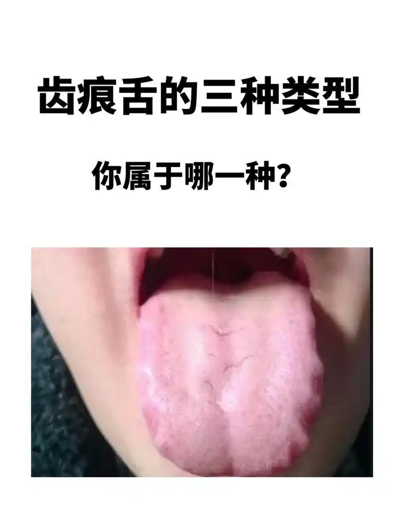 舌头上有齿痕主要原因,多见脾虚不能运化水湿,湿阻于身体反射在舌体