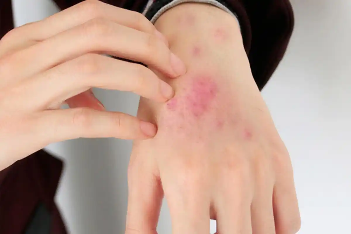 皮肤出现过敏,红痒该怎么办?1.去医院皮肤科就诊,找一下过敏的原因.2.