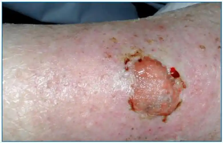 皮肤肿瘤和慢性下肢溃疡