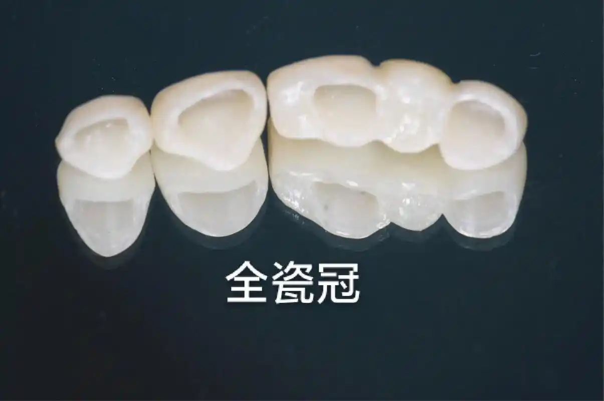 烤瓷牙和全瓷牙的区别.【今日07科普】烤瓷牙和全瓷牙区别?  - 抖音