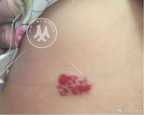 【妈妈须知】最容易忽视的婴幼儿血管瘤症状,你知道是什么吗?