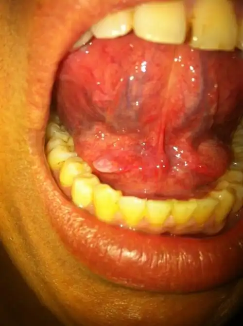 舌头底下长了个白色的包.