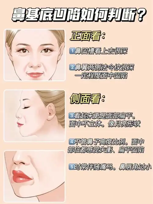 鼻基底凹陷法令纹自测教你如何区分和改善