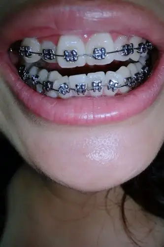 拔牙可以用社保吗 牙套能社保吗